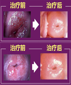 拯救子宮告別宮頸糜爛